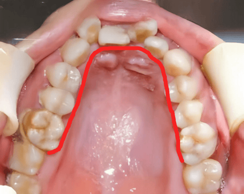 正常人上颚图片