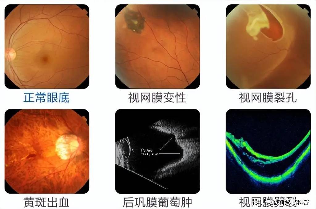 开角型青光眼,玻璃体混浊等6.白内障5.近视相关脉络膜新