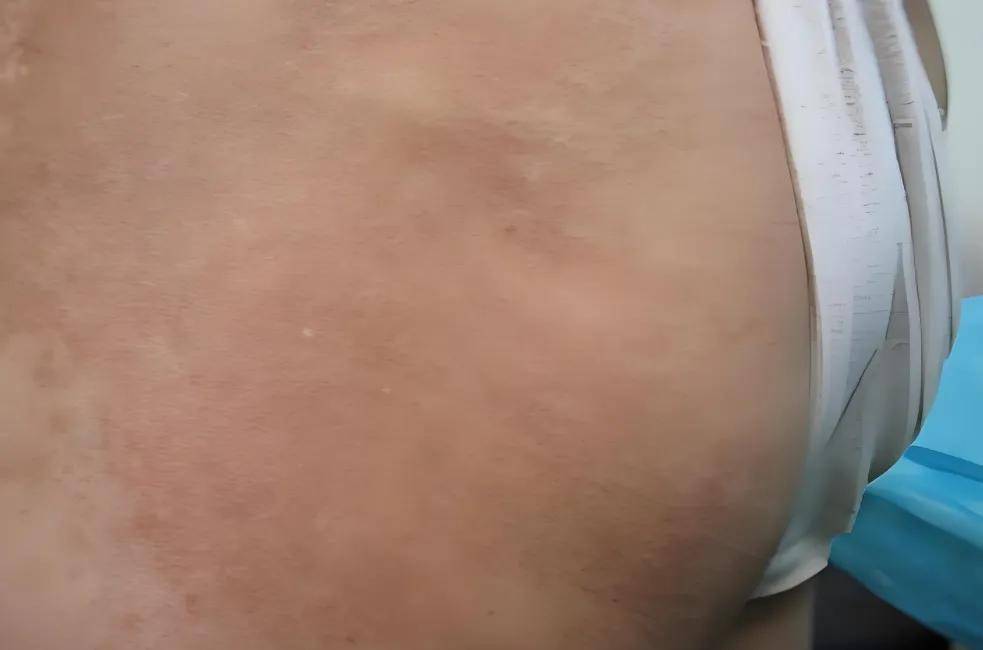 硬皮问题并非无解,硬皮不仅能控制,而且还能恢复八九成!