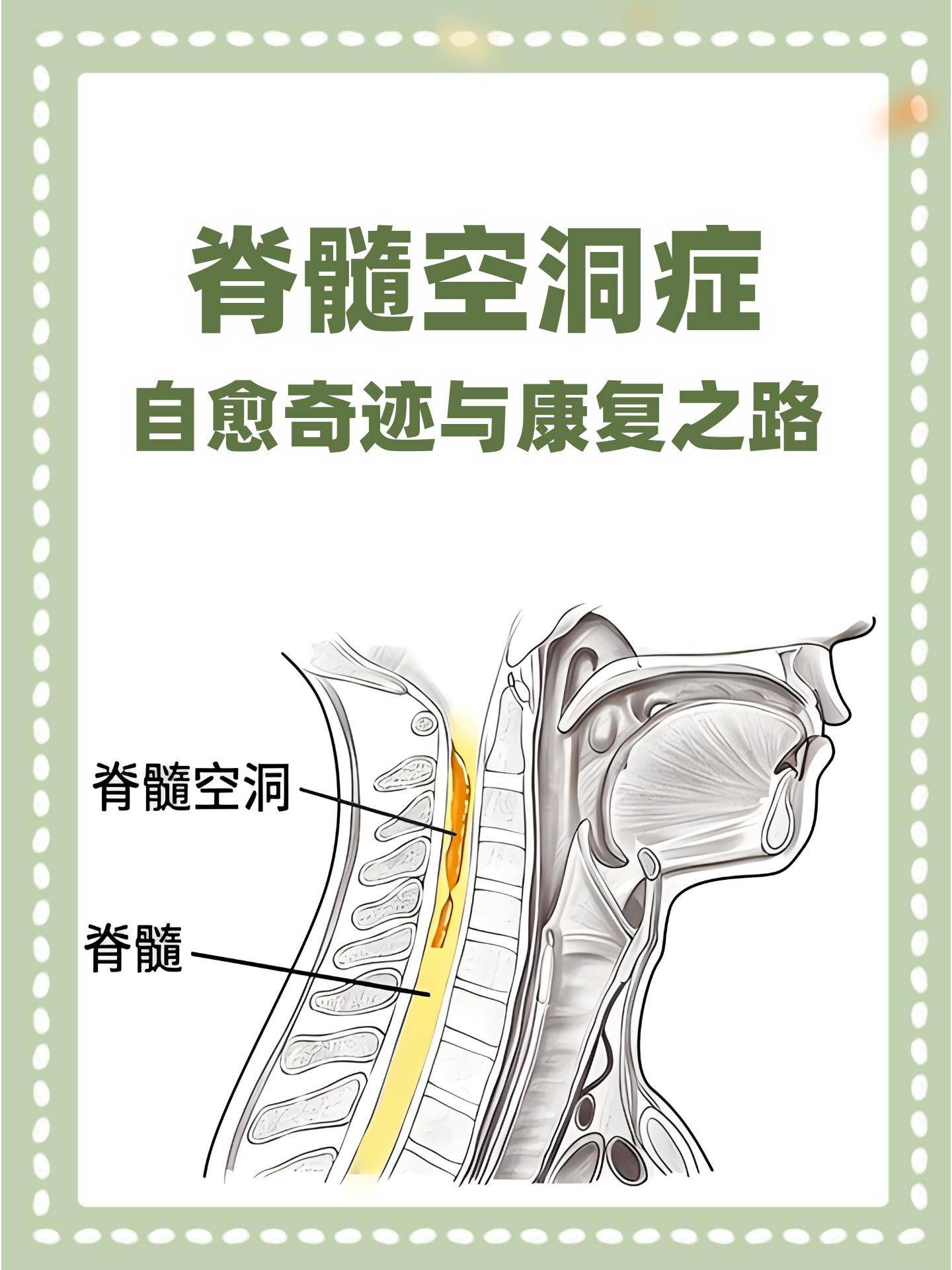 脊髓空洞如何康复治疗