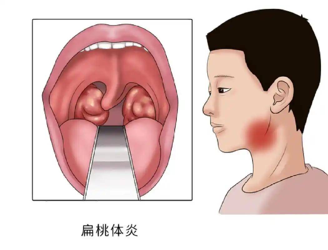 扁桃体肿大如何治疗