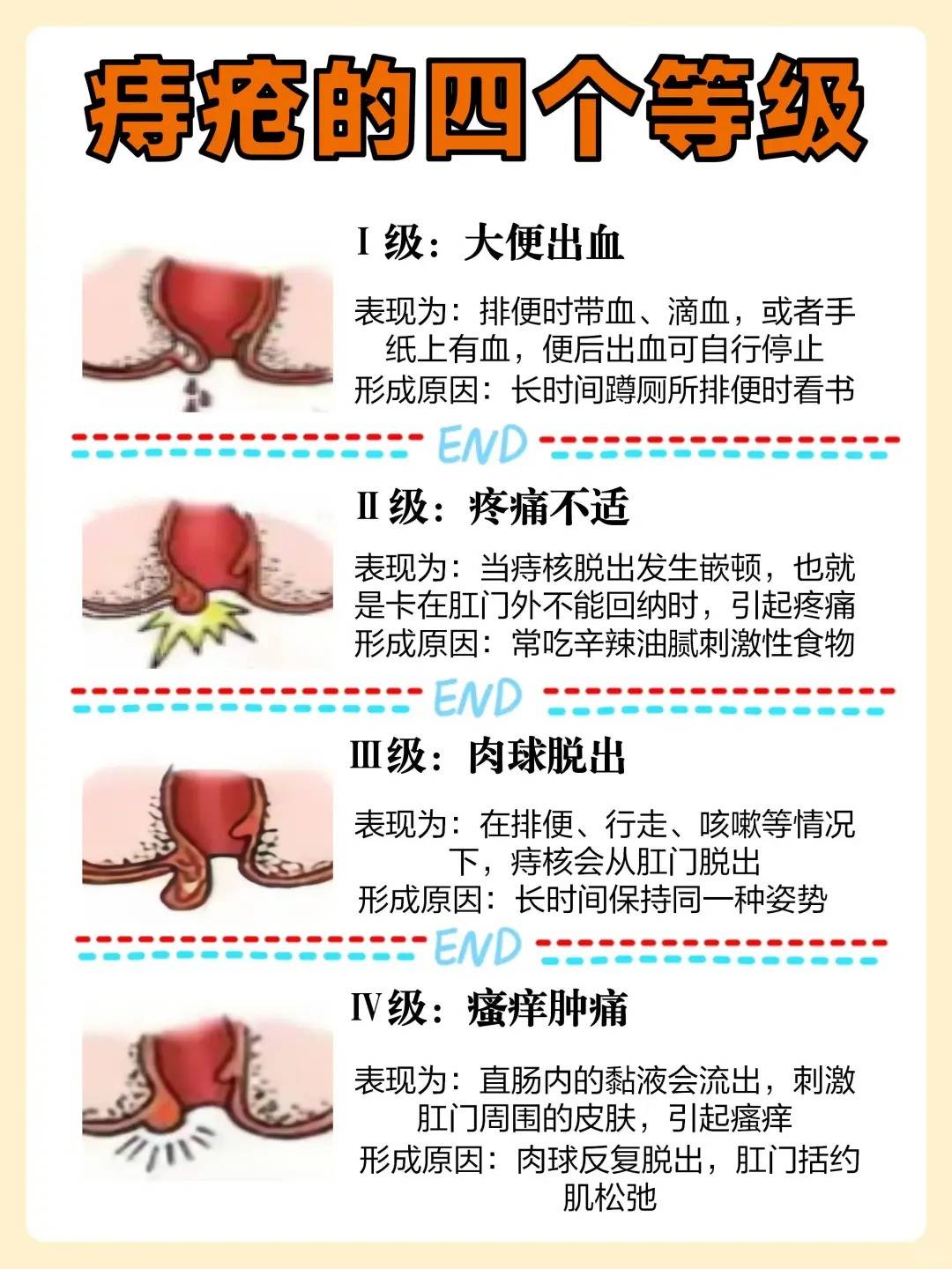 90%都不知道的去痔方法?