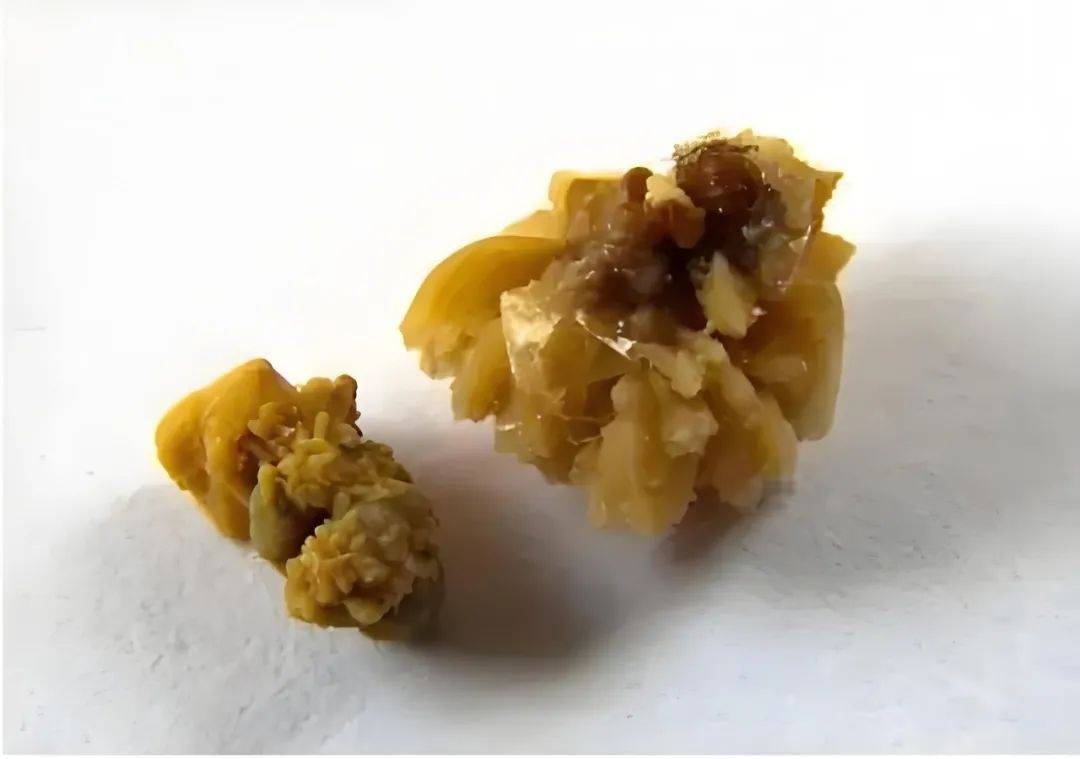痛风和痛风肾发生,和这两大结晶有关!痛风专家黄川云科普!
