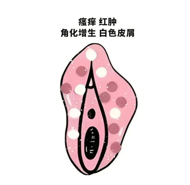 外阴白斑患者不要忽视这几个症状