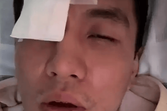 谁下手这么狠啊？郭艾伦眼睛在训练中受伤，未来可能打不了篮球