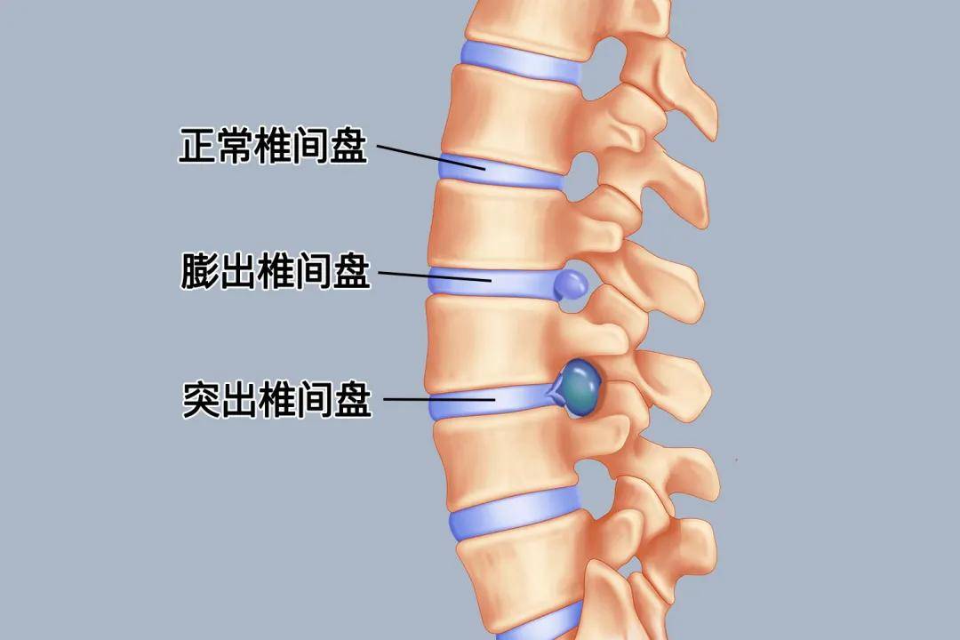 腰椎间盘突出的四个阶段,快看看你属于哪一个?