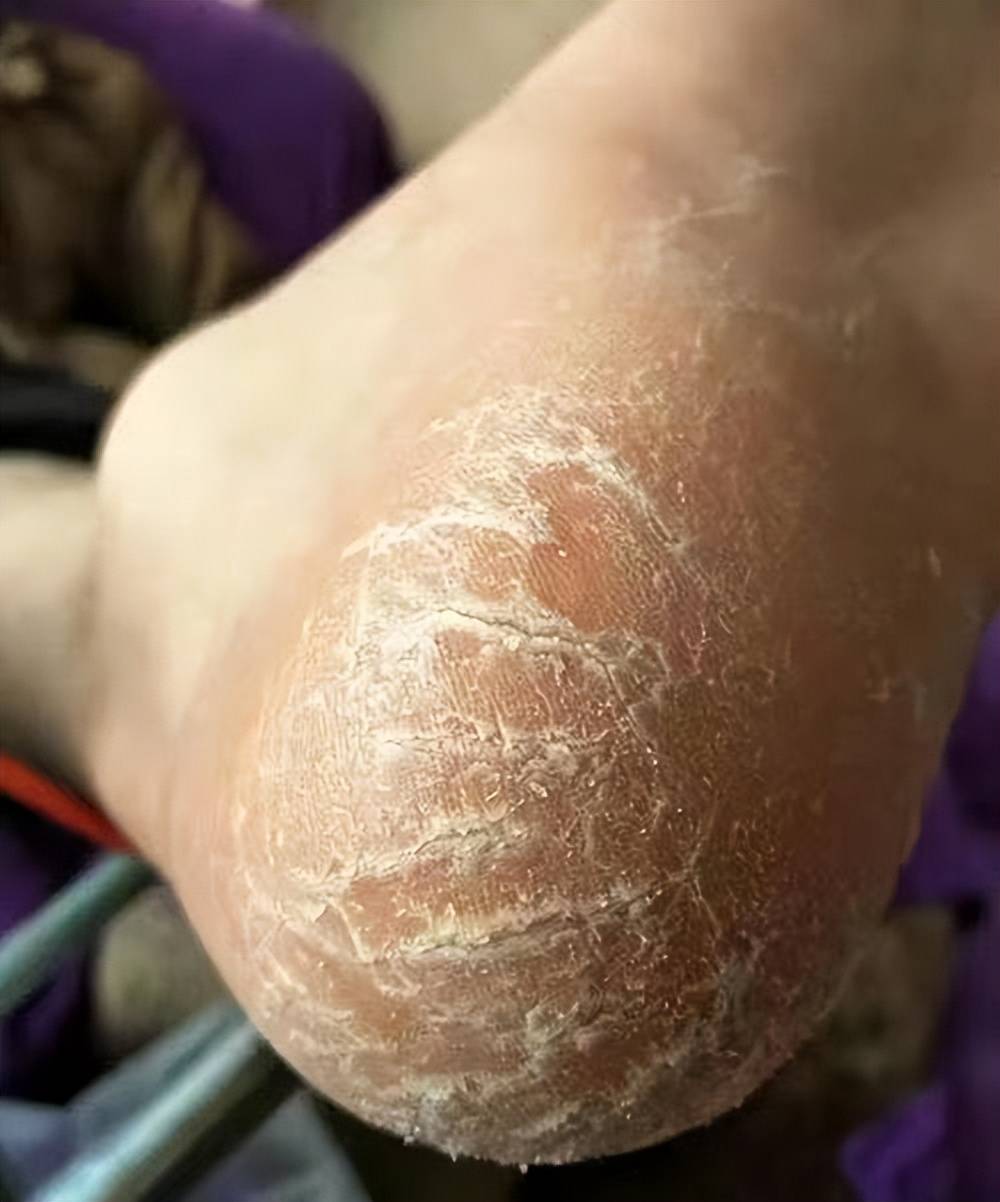 28天告别脚后跟,粗糙干裂克星大公开!仅此一次,别错过!