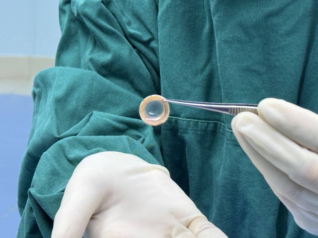 11 岁少年历经九年黑暗终迎光明 合肥普瑞眼科成功实施角膜移植重燃