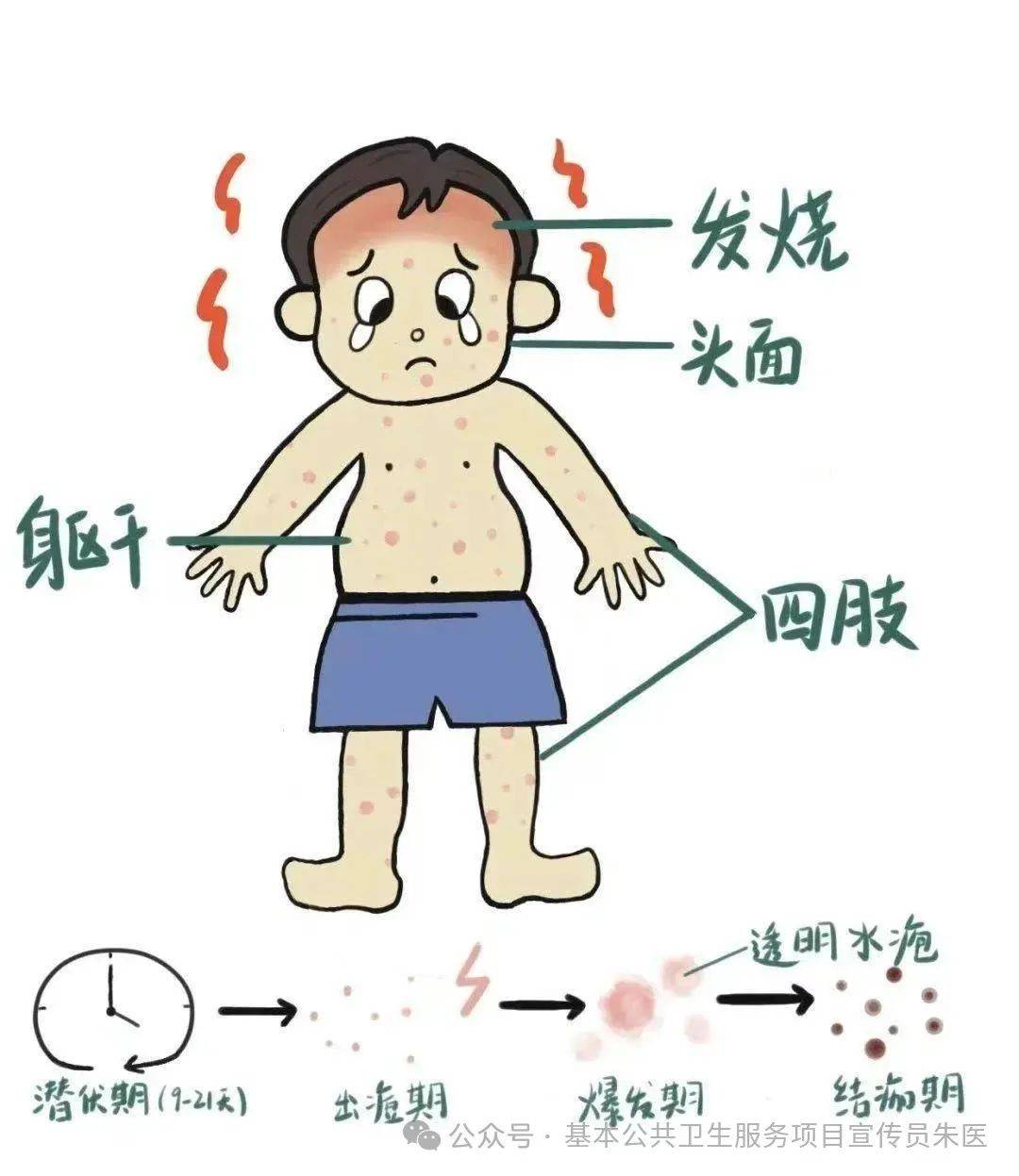 水痘科普知识 为您一站式备齐