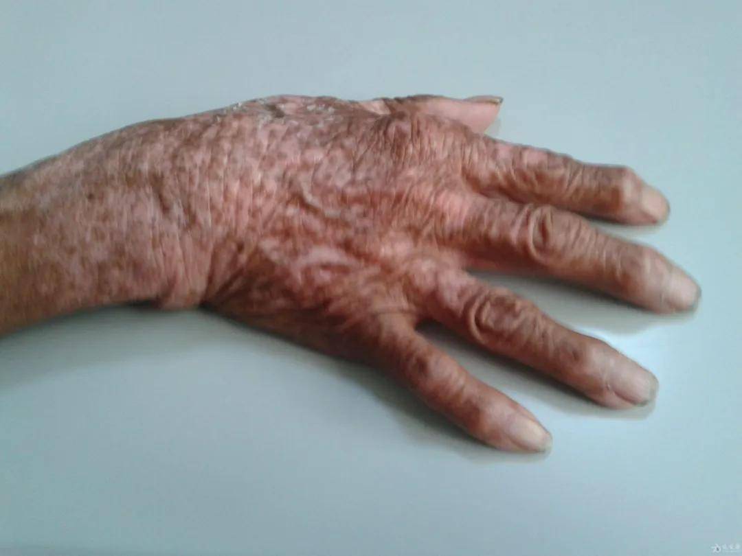 原来系统性硬皮病在发病之前,身体就已经给了这么多的"预警信号"了!