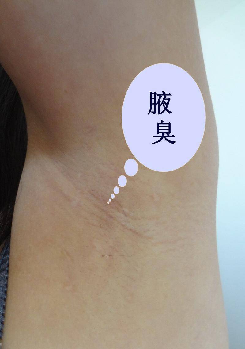 探究腋下出汗异味,体味难闻狐臭现象的解决策略