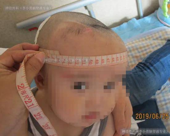 婴儿脑外伤后脑积水,家长不愿放管治疗反致头增大,落日征,脑室变巨大