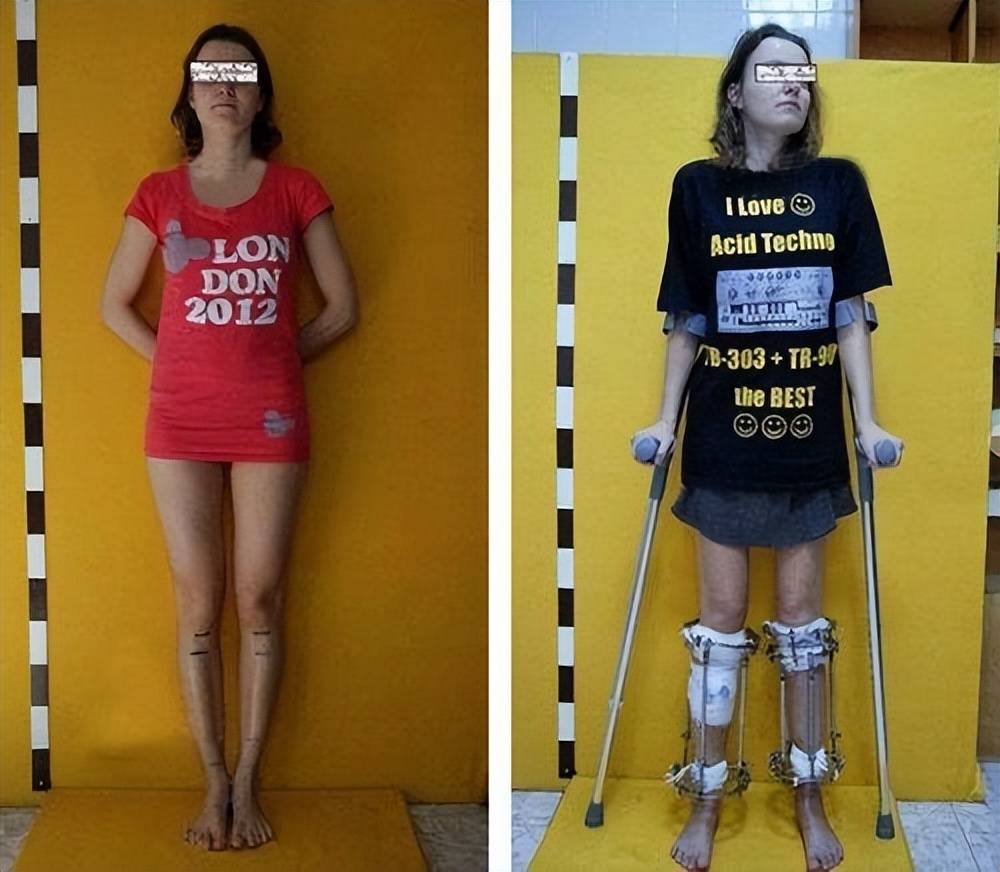 女子花60万去国外"断骨增高",术后疾病缠身,无法正常奔跑下蹲