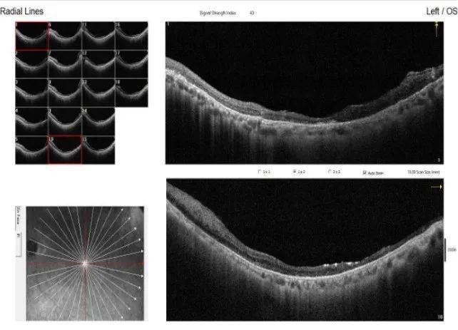 一位视网膜脱离患者找回了光的希望
