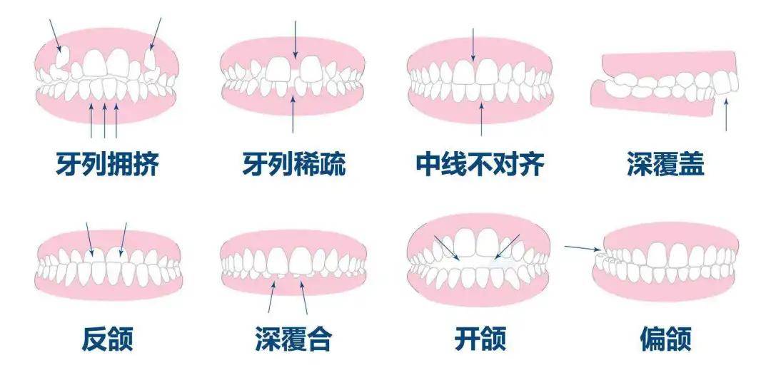 正确的牙齿咬合图是什么样的