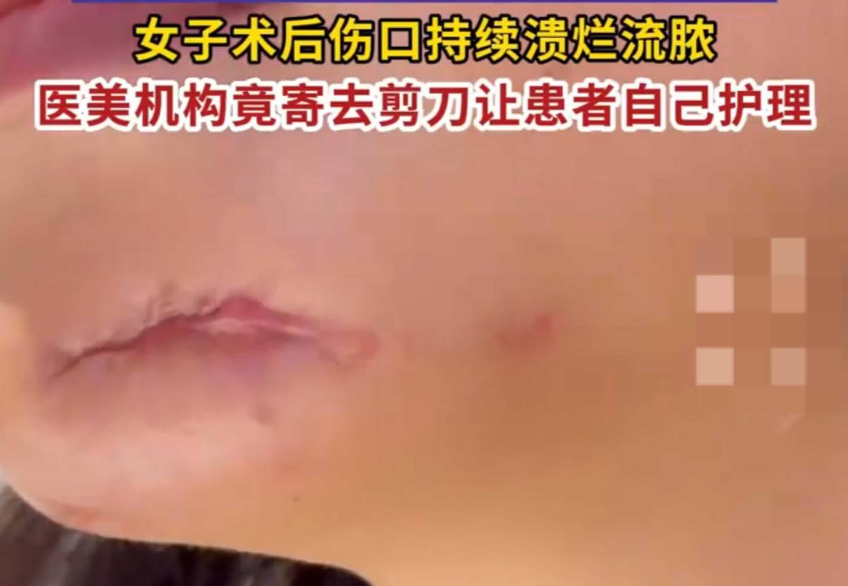 女子在徐州予美医美取生长因子烂脸 机构寄剪刀让其自行处理(图1)