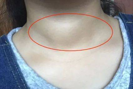 超声报告上的弥漫性病变严重吗甲状腺报告没有这四句话就不用太紧张