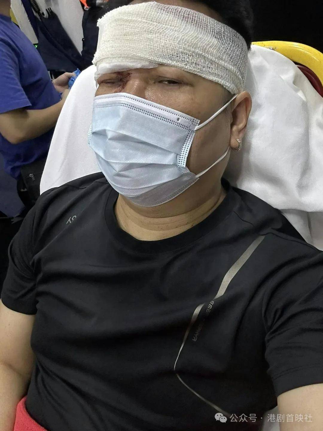 56岁歌手发生车祸双眼瘀青劲肿,曾红极一时瞒婚生子15年