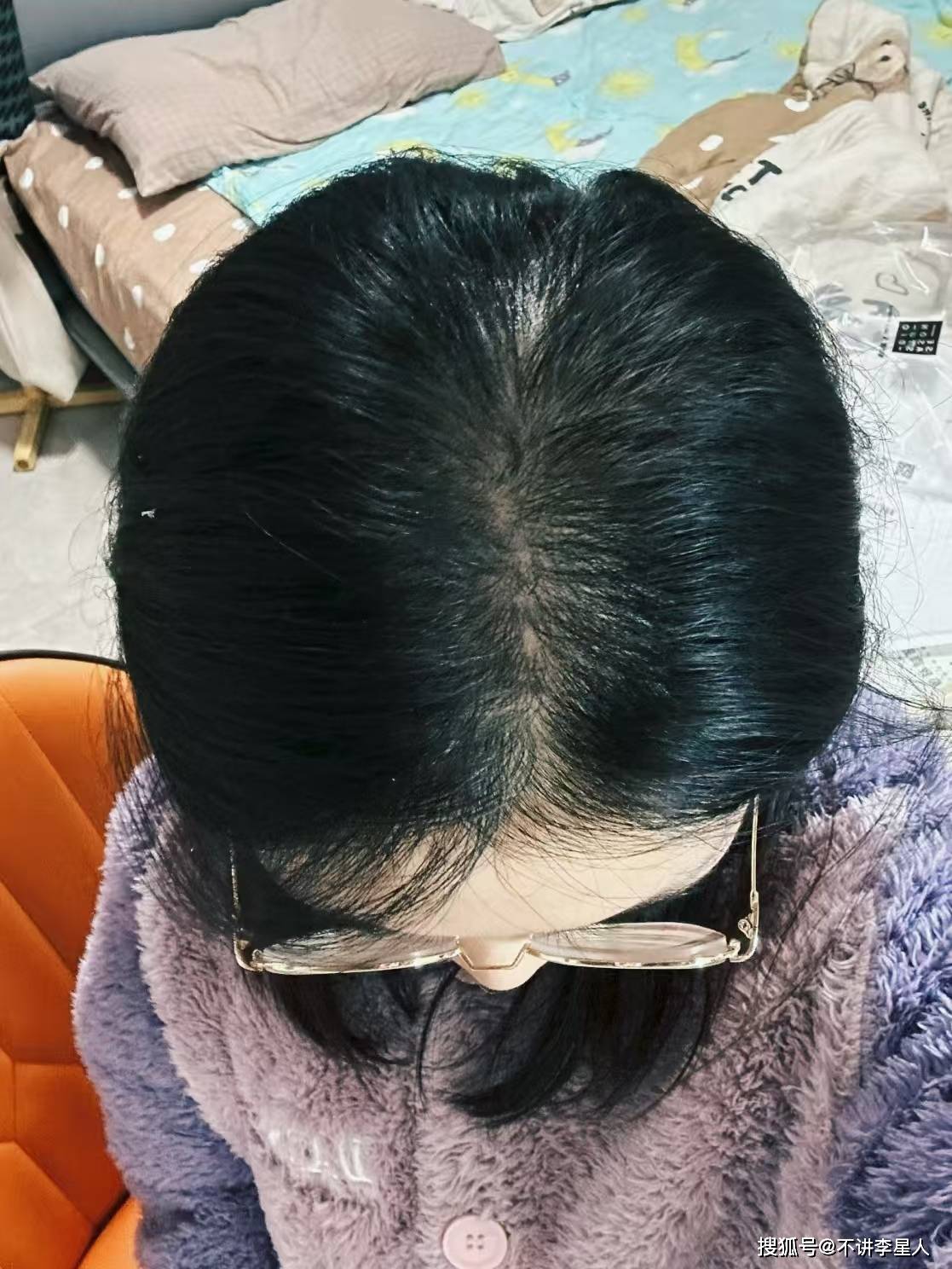 作为一个天生细软塌发质的人我多年来一直与头油头屑和脱发问题作