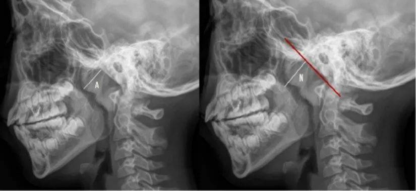 【高尚病例】腺样体肥大