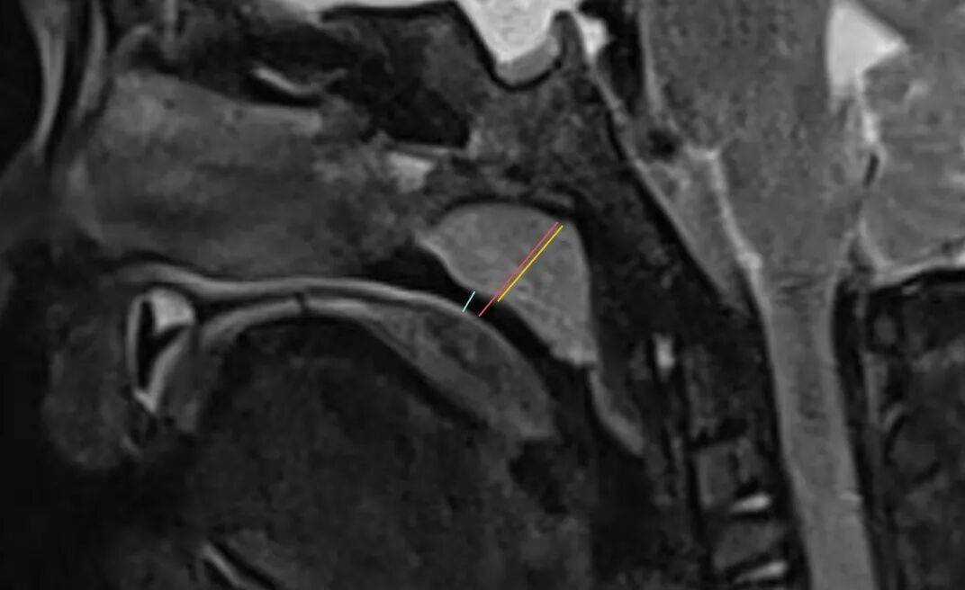 【高尚病例】腺样体肥大