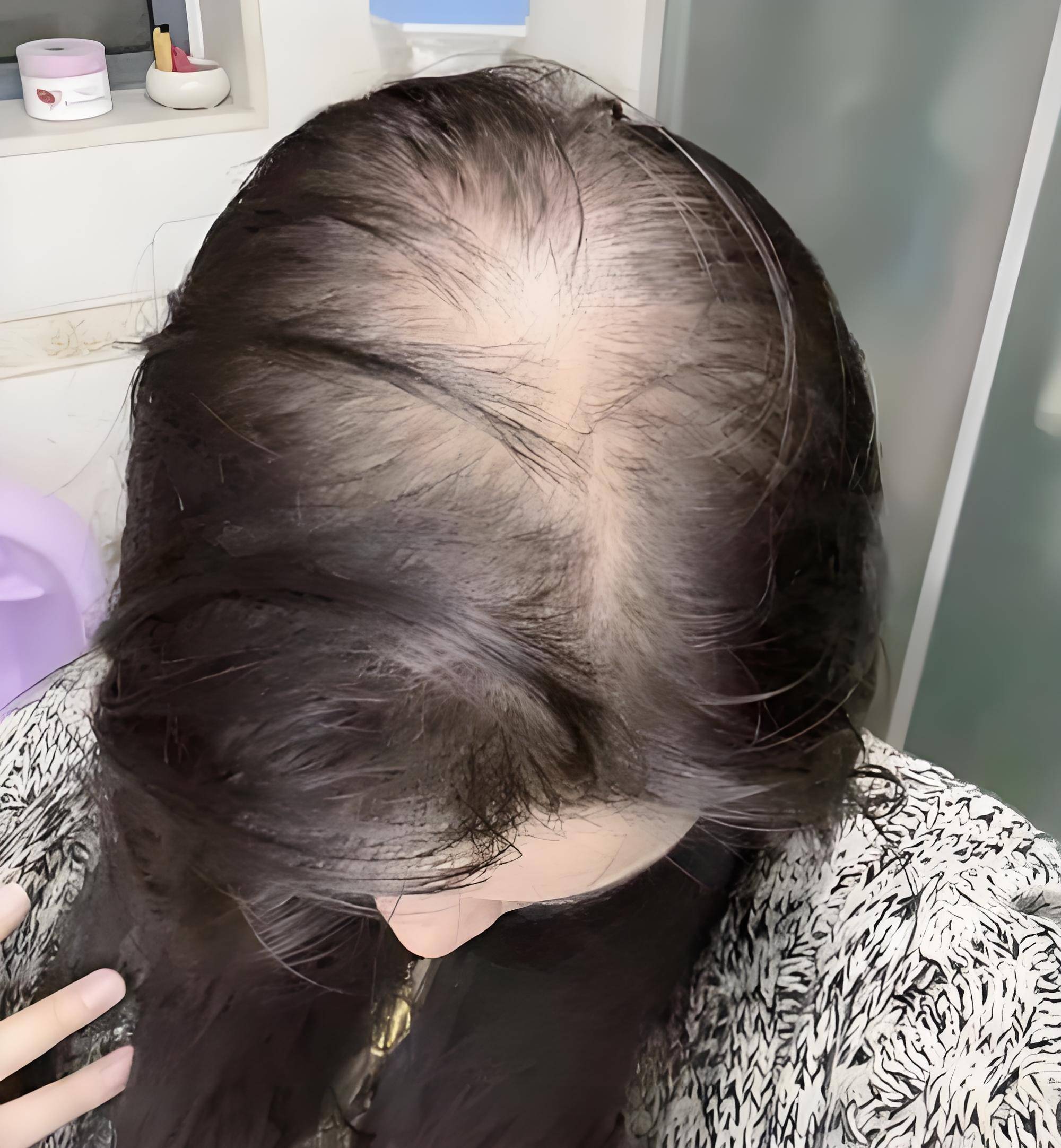 头顶头发稀少怎么办?私传最有效的生发方法让头发悄悄回归
