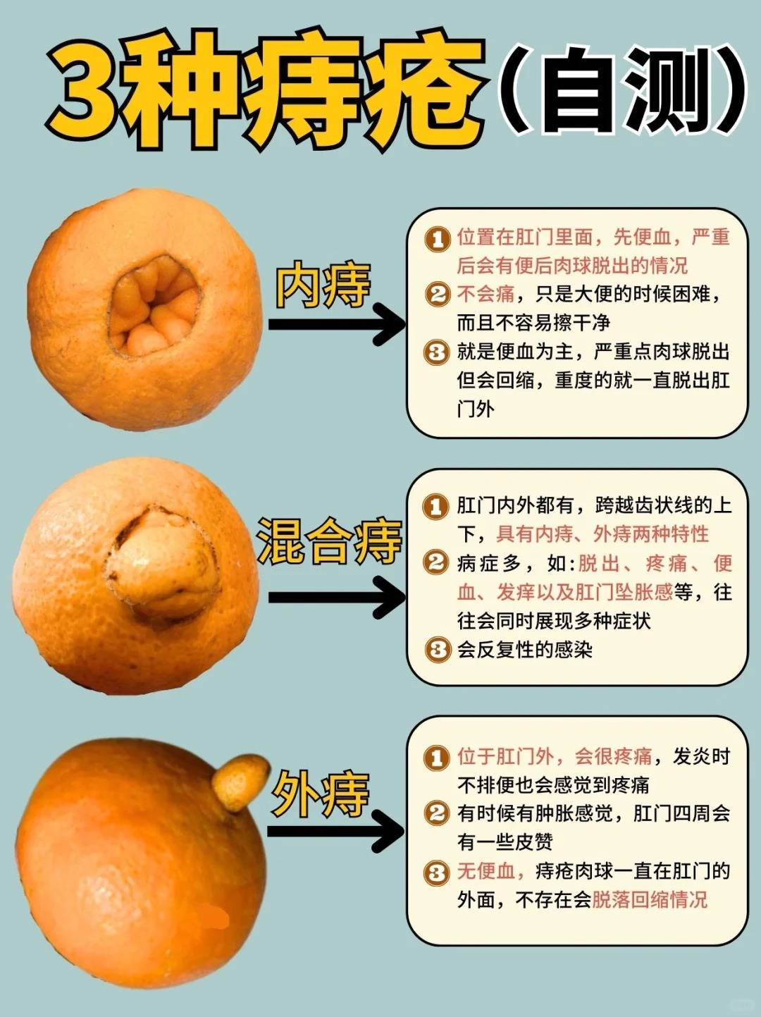 "十女十痔"为什么女性更容易得痔疮?痔疮最实惠的解决方法?