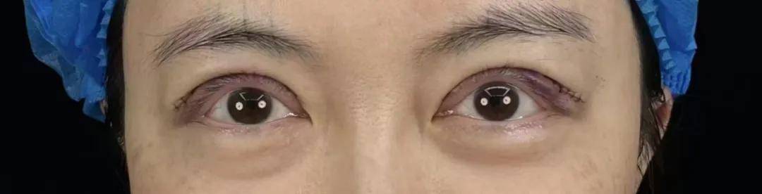 做了手术闭眼困难 瑞格医美楚院长的术后案例被曝修图后发布(图5)