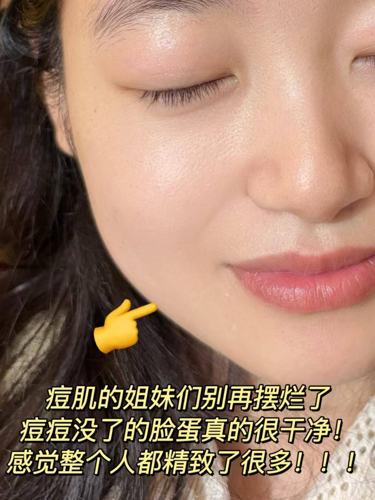 青少年闭口修护专家温和改善痘印屏障受损
