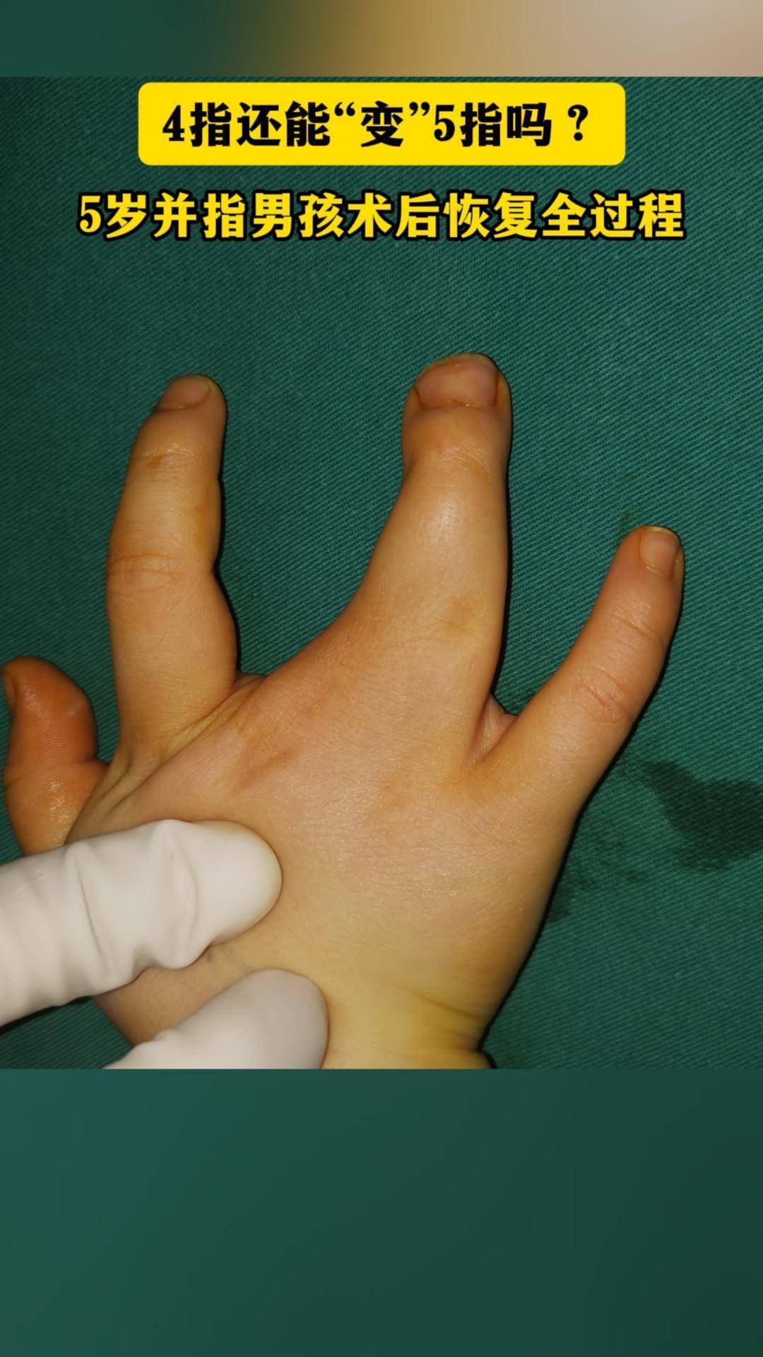 4指还能“变”5指吗?5岁并指男孩术后恢复全过程