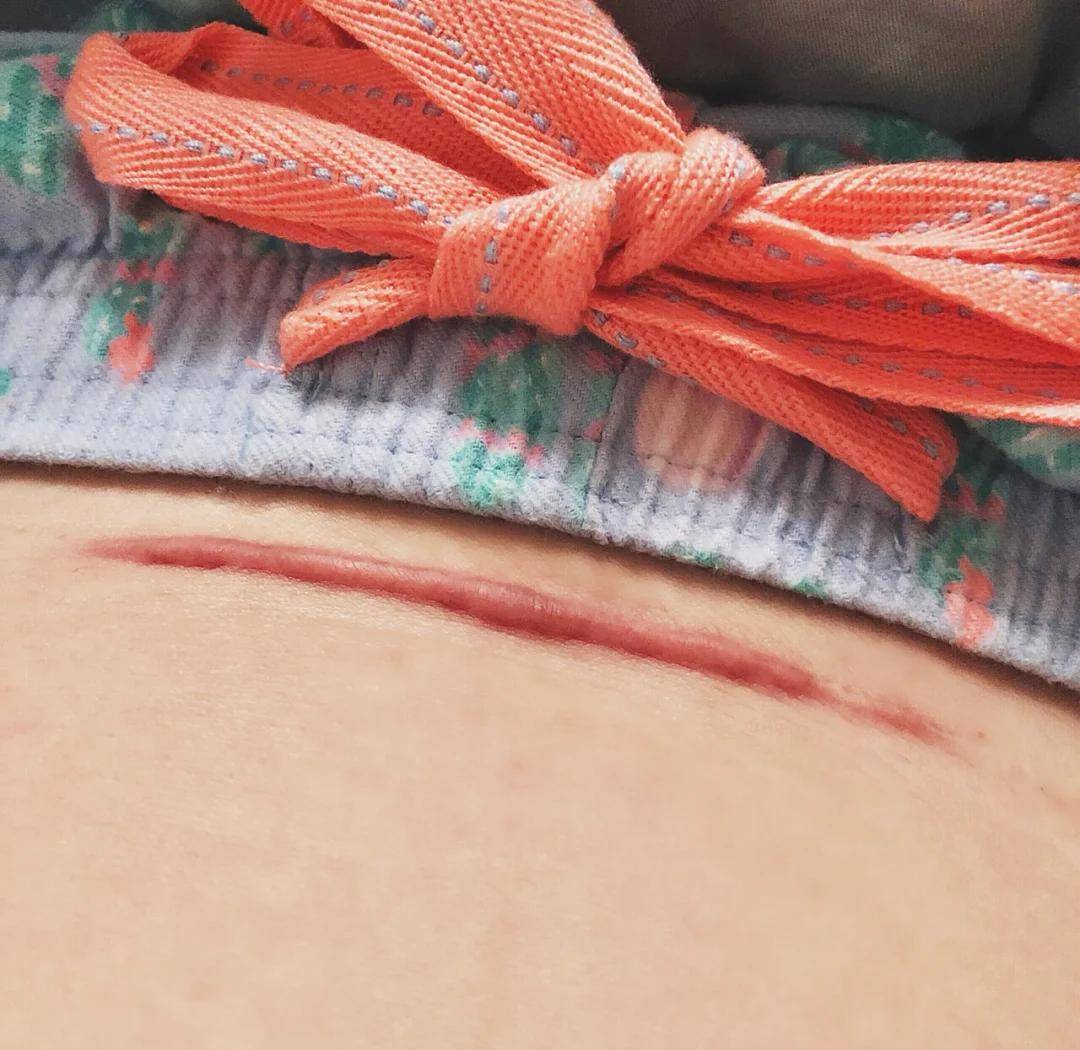 生育损伤是注定的吗?不用就医,忍一忍就好！