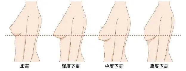 20多岁就胸部衰老干瘪下垂,只需6招实现胸部逆生长！