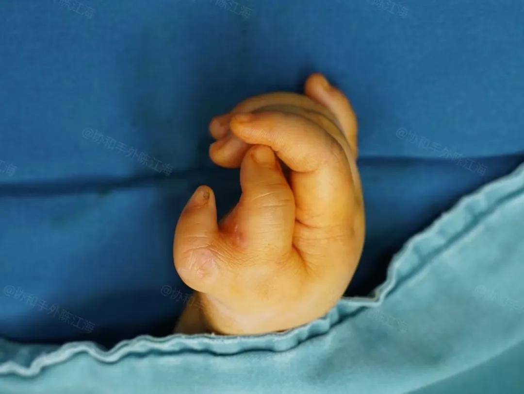 原创            《多指案例60丨人生的苦总是有限的，他是不会一直吃苦的》