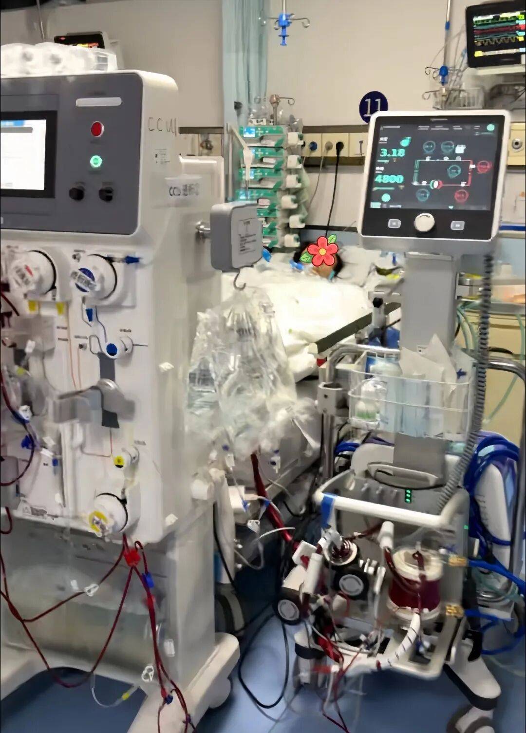经过24天的精心治疗与护理患者成功脱离了ecmo呼吸机等生命支持设备