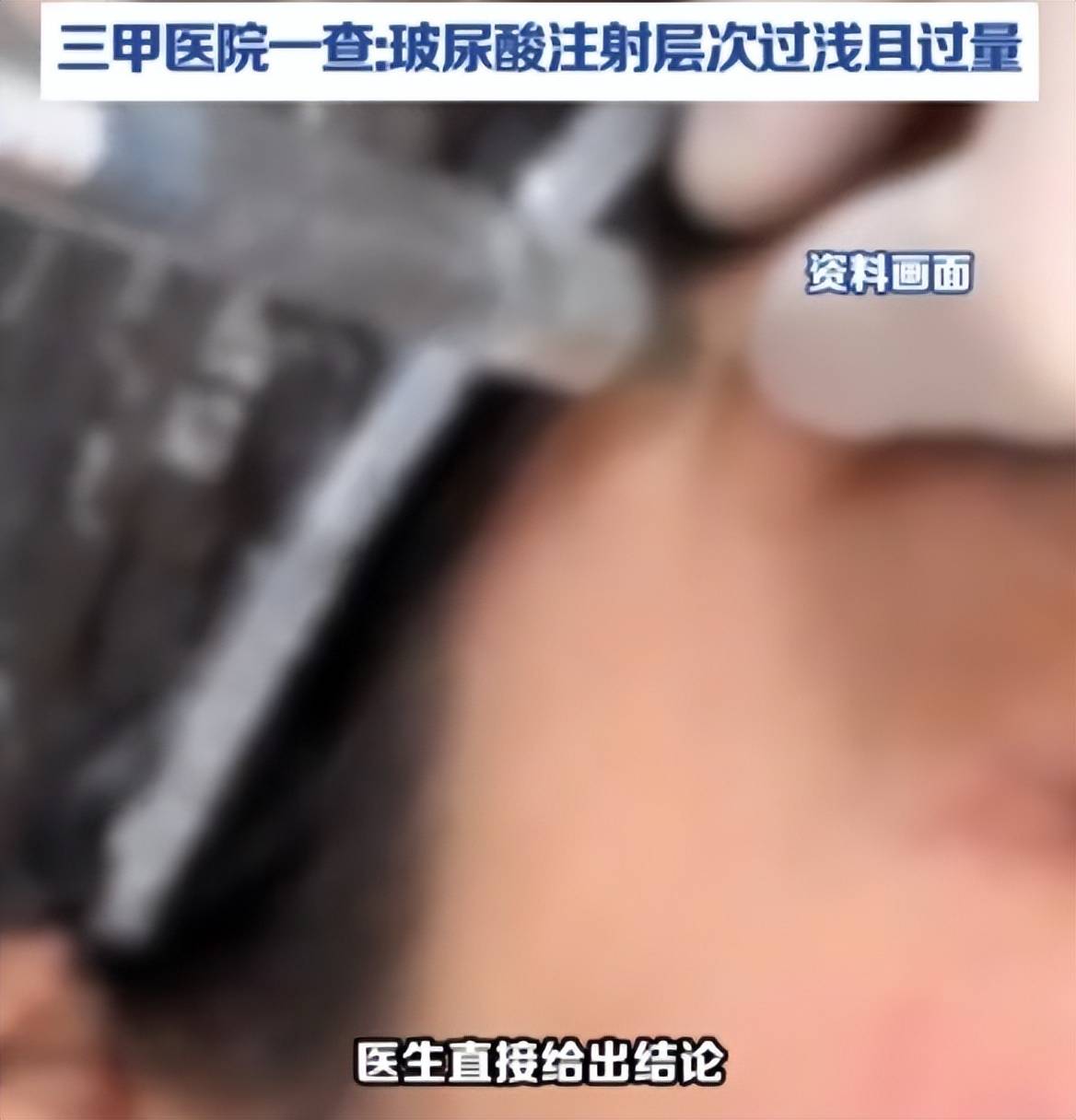 定制“头包脸”需谨慎:西安东方丽诚注射太阳穴被曝鼓大包(图4) get?code=YTY1MGI4MDUwNzJkZWU2ODY3YTlkMDIxNDEzNzgzYzksMTc3NDc0OTIyMDE1NA==