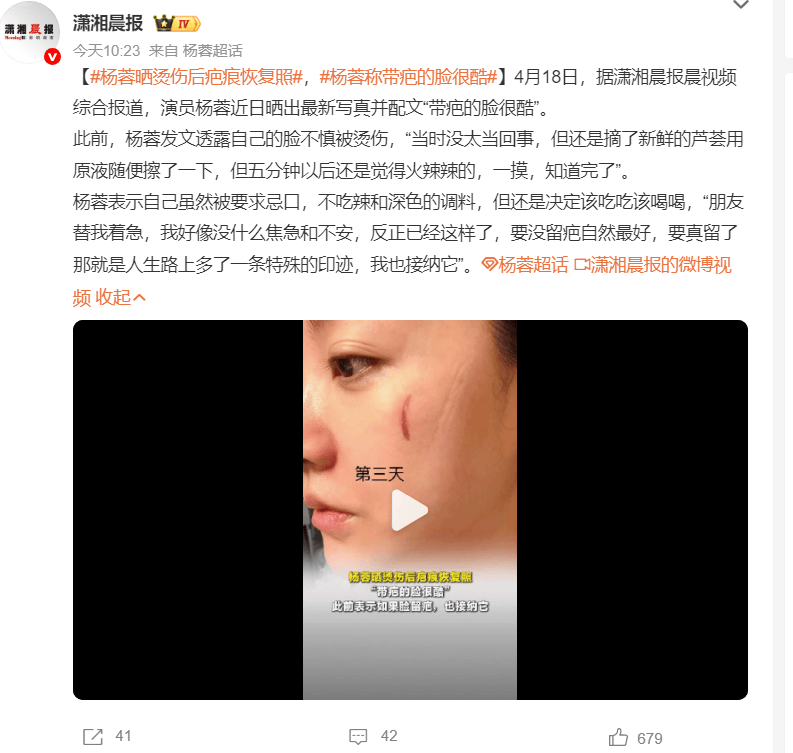 杨蓉晒烫伤恢复照 乐观称带疤亦酷展现豁达态度