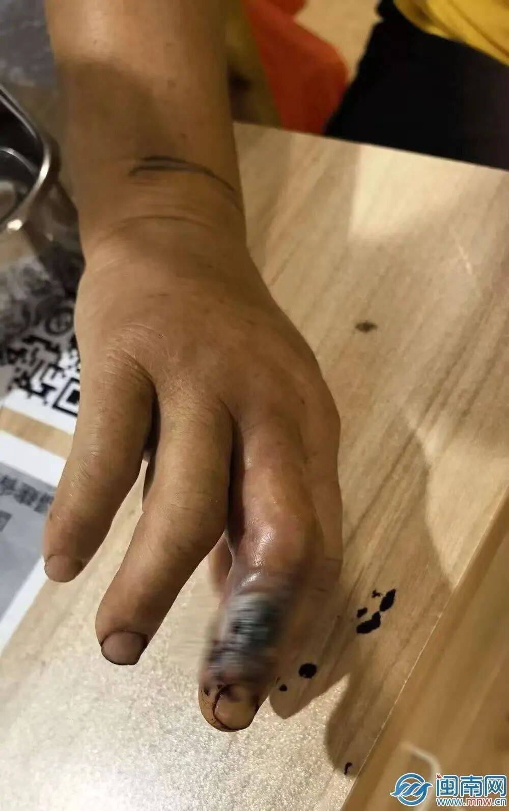 硬核自救！53歲阿姨菜地被蛇咬，徒手活捉2米長眼鏡蛇帶到醫院海報