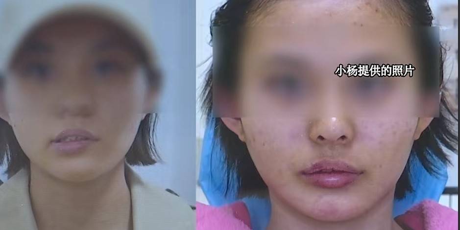 被"杭州第一扎女"注射后脸歪 杭州美莱医疗网红医生也翻车?(图4) 文章配图-1