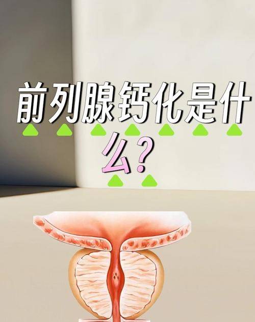 前列腺钙化，男人的“沉默结石”？别慌，这篇给你讲透！