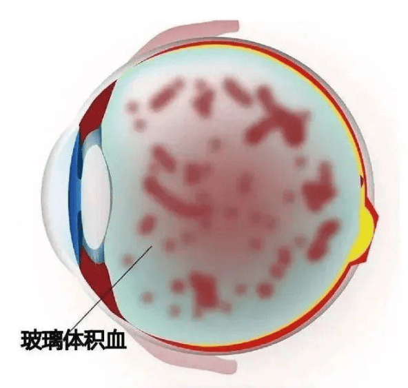 老中医临床经验：糖尿病眼底出血，两步法吸收眼底淤血