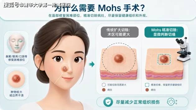 皮肤美容科联合病理科开展Mohs显微描记手术，为皮肤肿瘤治疗提供精准微创解决方案