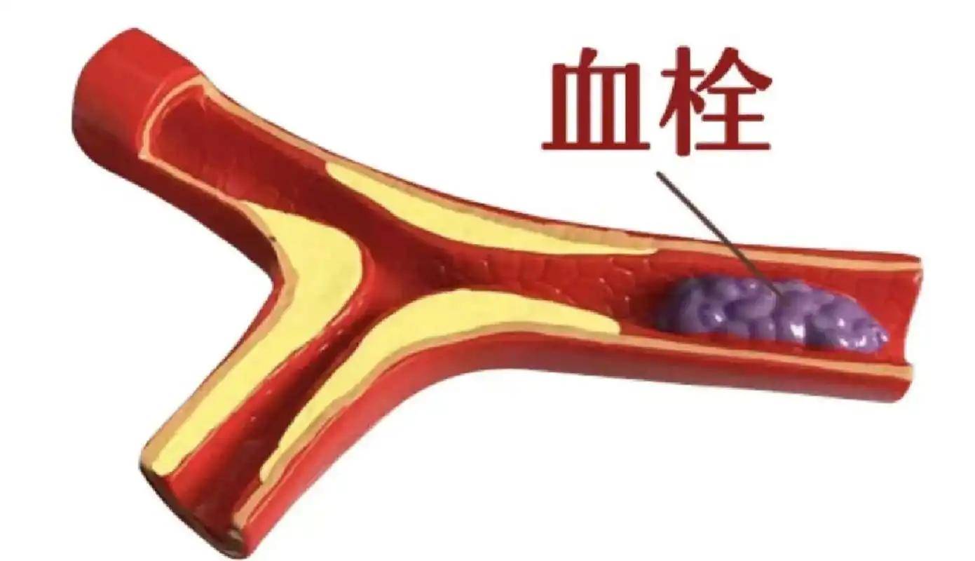原创            人有没有血栓，喝水就知道？体内有血栓的人，喝水常有这 5 个表现