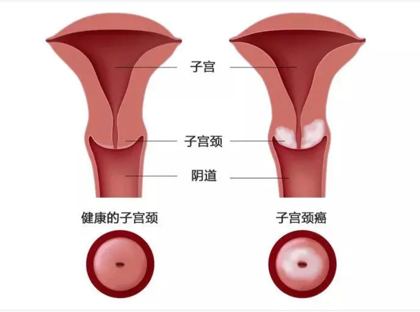 阴道出现异味是女性宫颈炎非常典型的症状,尤其是慢性宫颈炎,当女性得