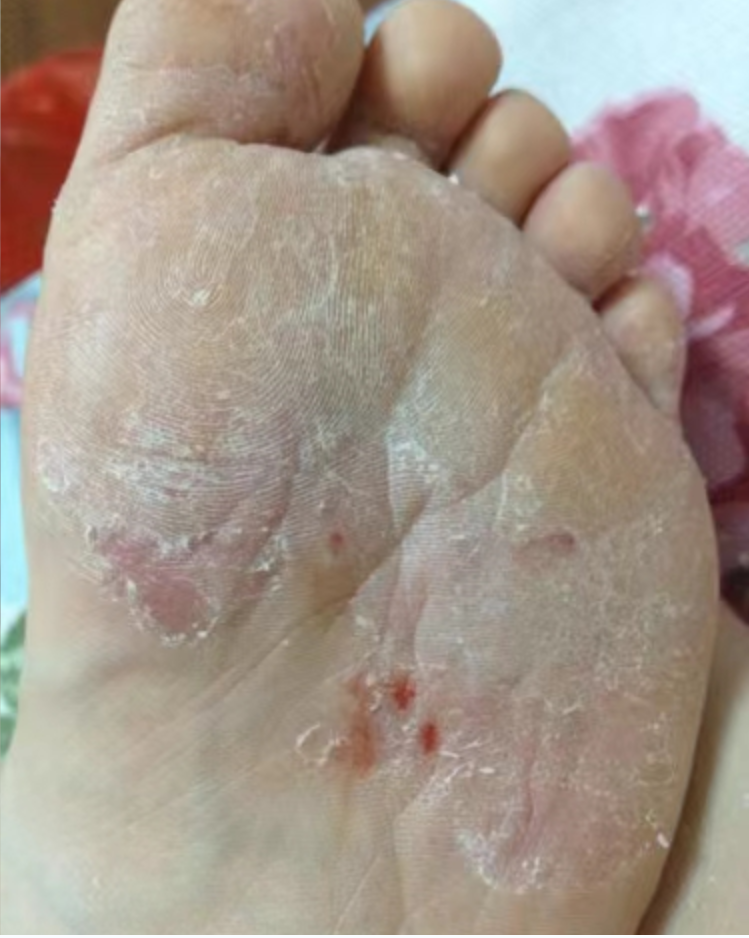 新年将至不想被脚气困扰?这篇文章给你解决脚底糜烂瘙痒问题的答案