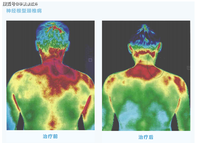 正中线是正常人体热成像图的标志,两侧相对应测温点的颜色基本相同;项