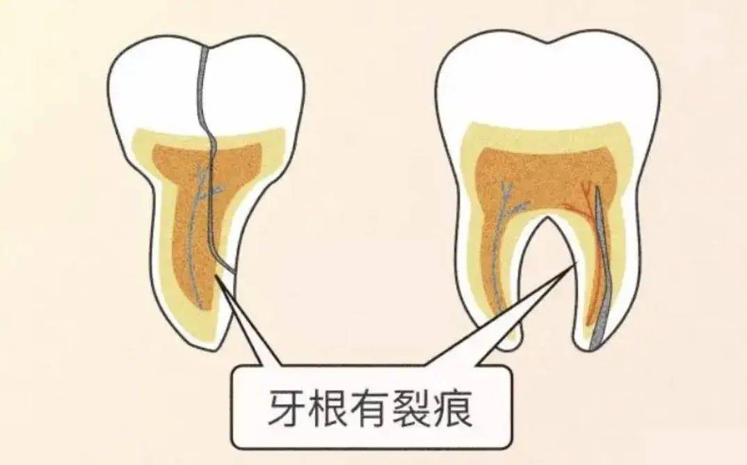 3,重度隱裂患者通常表現為患牙一遇冷熱刺激就疼痛,或患牙不能咬硬