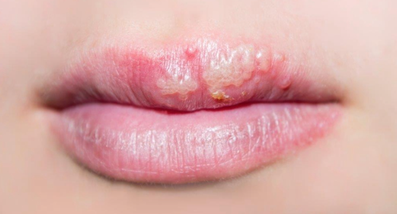 如何处理不同类型的唇炎?