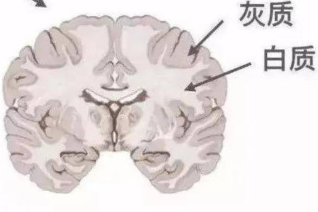 脑白质病变是一种神经系统疾病,引起了人们的广泛关注和疑虑.