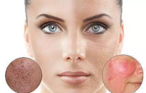 微生物组促进表皮自愈更新消退痘印3,选用抑制痤疮杆菌生长的膏霜,并