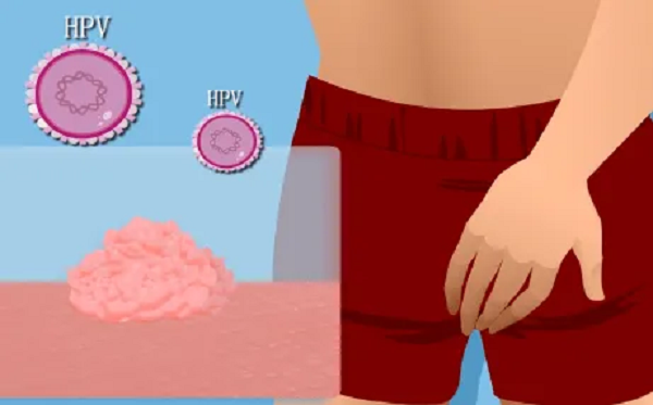 科普丨正确认识hpv6,11感染引起的尖锐湿疣_治愈_性生活_方式